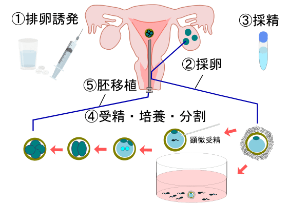 体外受精の流れ ※日本産婦人科学会資料参考